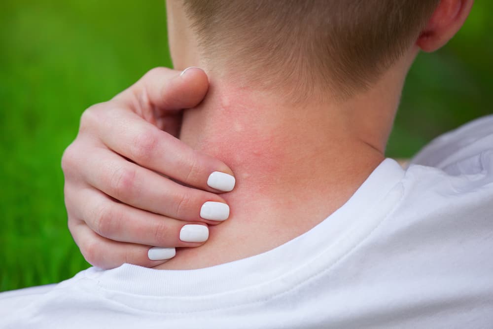 Neck of woman hiker covered with mosquito bites